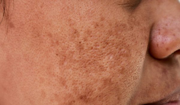 melasma e os beneficios do acido mandelico 1